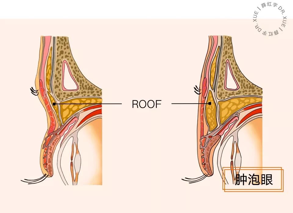 三层眼皮女人的特点,哪种眼皮最好看
