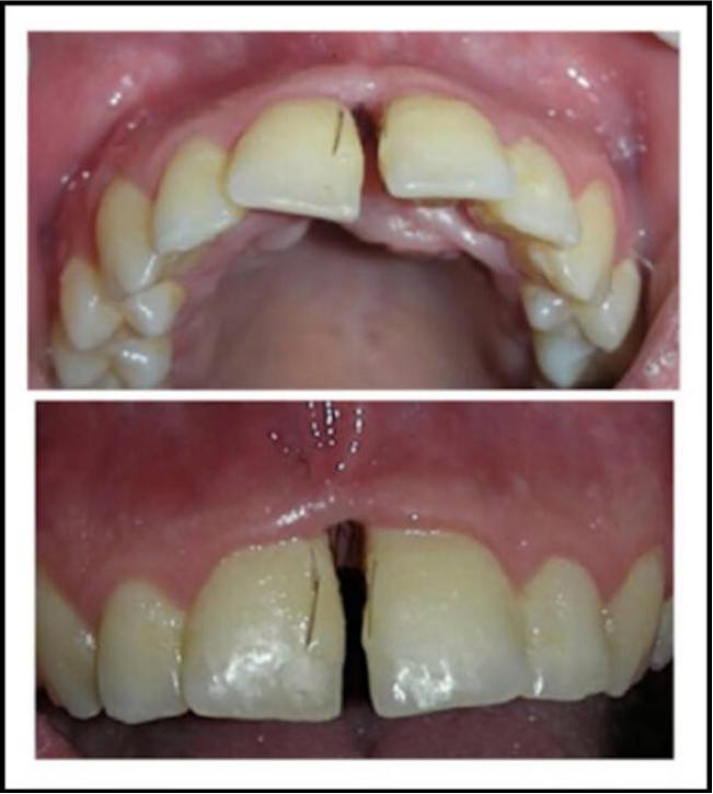 一女子患上罕见牙龈多毛症,牙齿里竟然长出了毛发