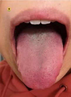 舌诊图解与针灸治疗,古法针灸点穴大全视频