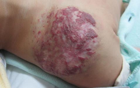 女婴右肩斑块连结混合型血管瘤生长迅速