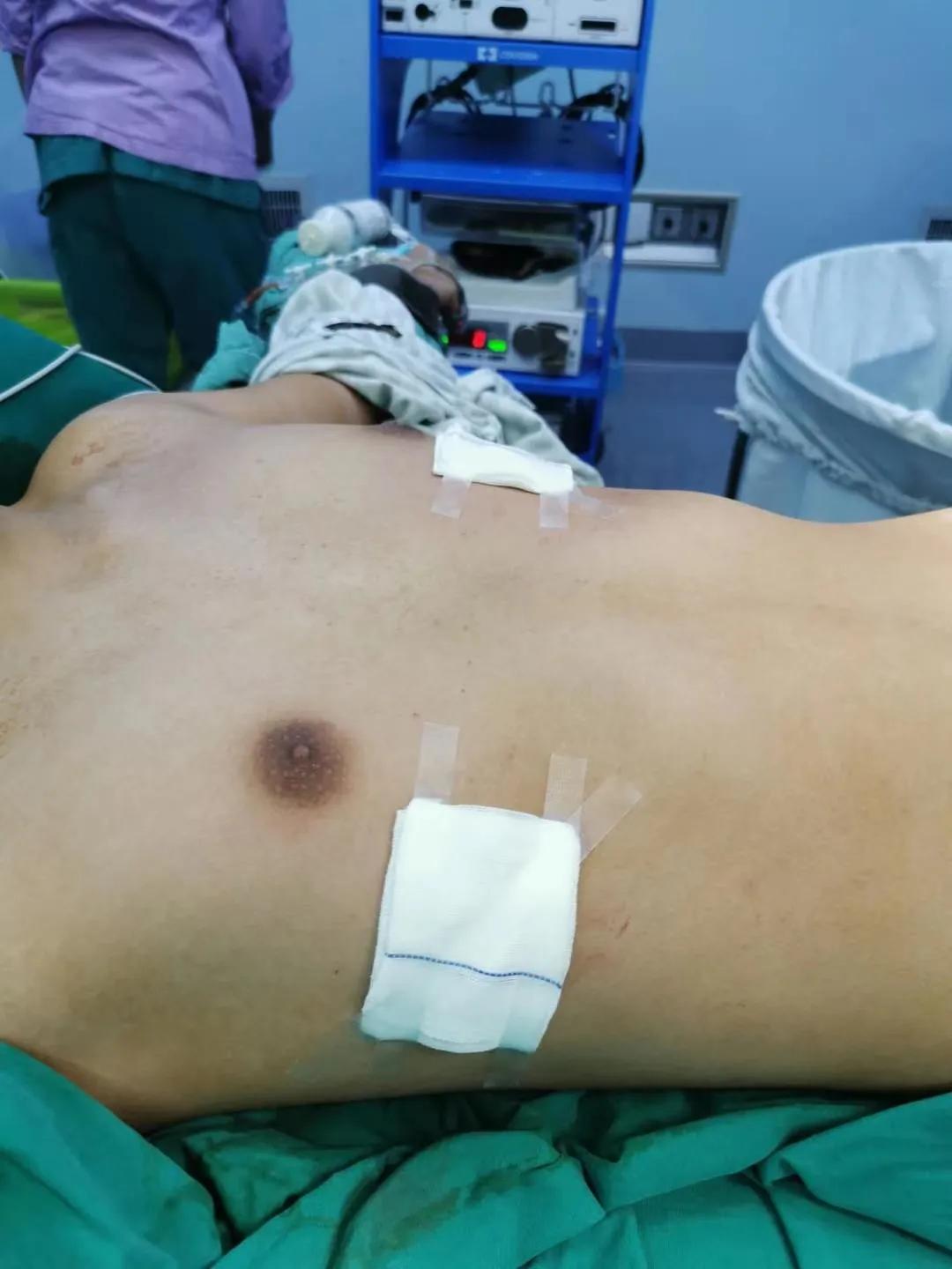 胸前肋骨两侧凹陷属于漏斗胸吗,胸口凹陷一个小坑一定是漏斗胸吗