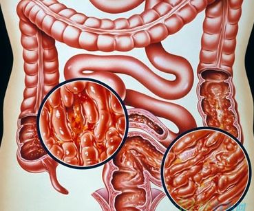 溃疡性结肠炎怎么破？这个不用太着急，用艾灸试试也许效果不错