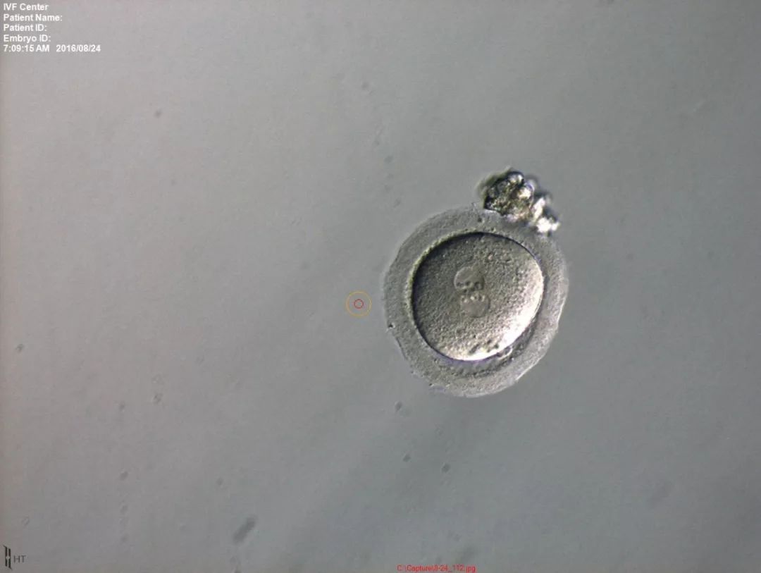 试管取完卵不麻醉过程疼吗,北医三院试管采卵需要麻醉吗