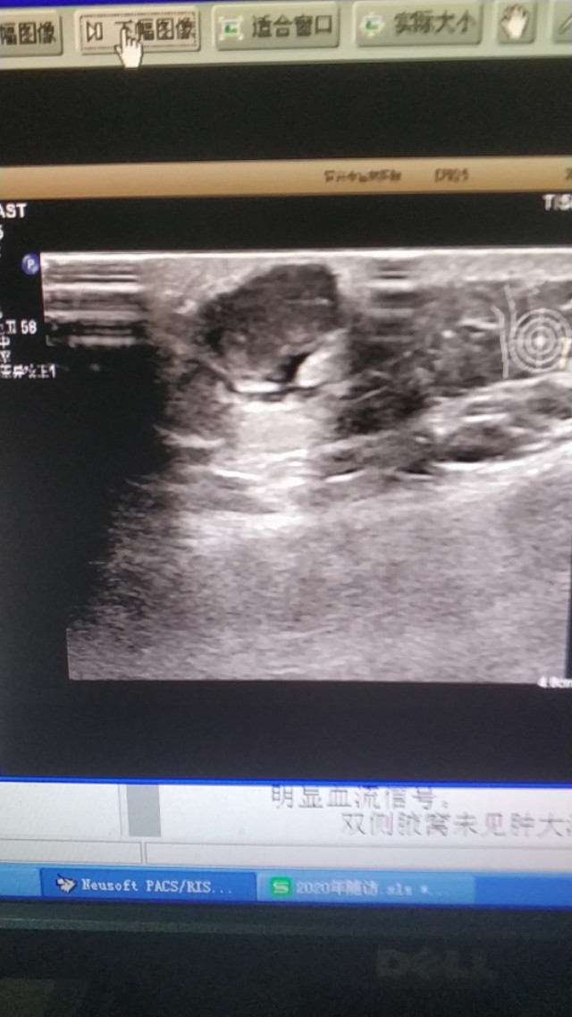 皮脂囊肿简介,皮脂囊肿和脂肪囊肿的区别