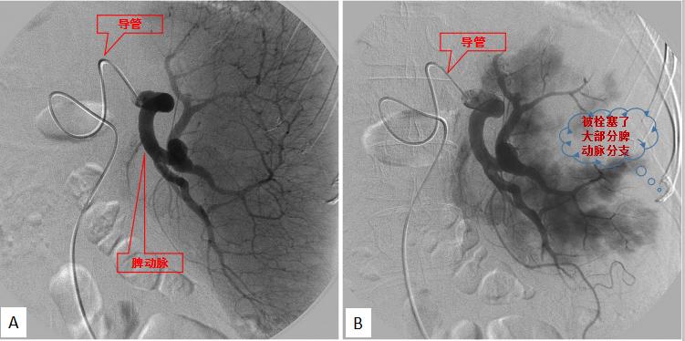 引起脾亢的原因,脾亢一定要切除吗