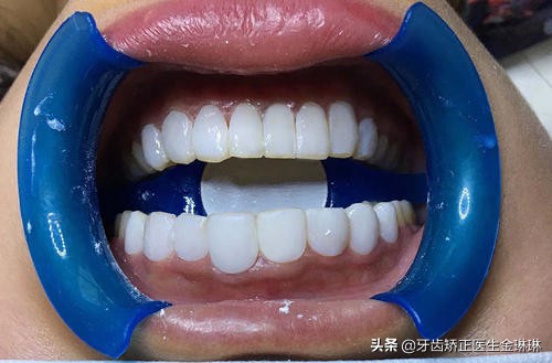 现在最好的烤瓷牙材料,做的烤瓷牙有点黄怎么补救