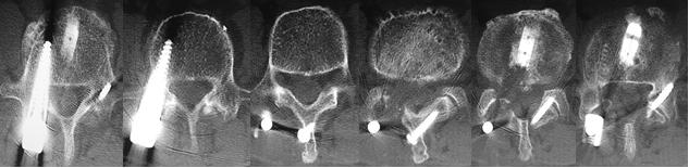 大姐腰椎间盘突出，陈明博士微创治疗，你信吗？