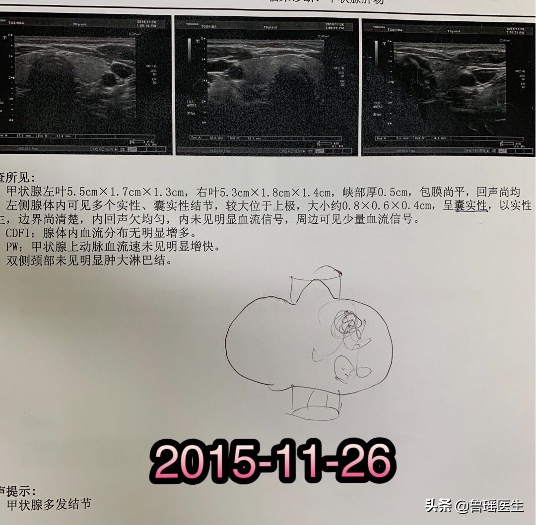 甲状腺穿刺v600e突变是什么意思,b超甲状腺结节误判率