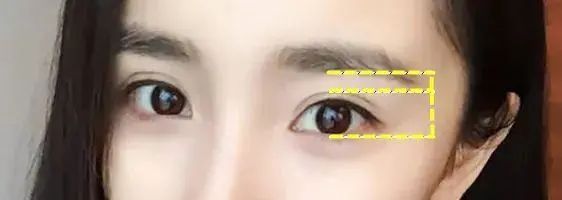 双眼皮形态分类,割双眼皮形态