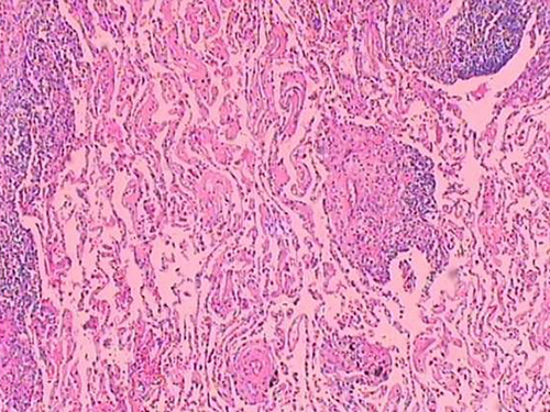 胸膜间皮瘤有哪些症状,胸膜间皮瘤病理分型