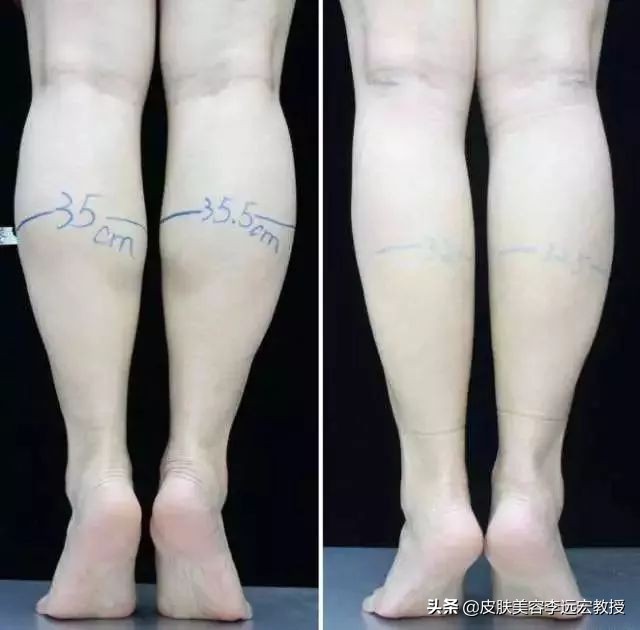 大腿小腿增粗怎么练,大腿粗小腿结实怎么办