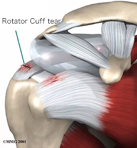 健身卧推肩膀受伤怎么恢复,卧推肩膀受限如何改善