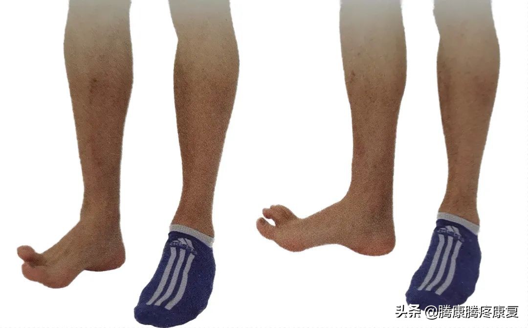 跟腱炎临床诊疗指南,跟腱炎起因和治疗