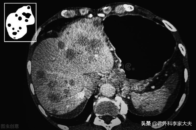 肝癌晚期介入术后饮食,肝癌晚期饮食用破壁机好吗