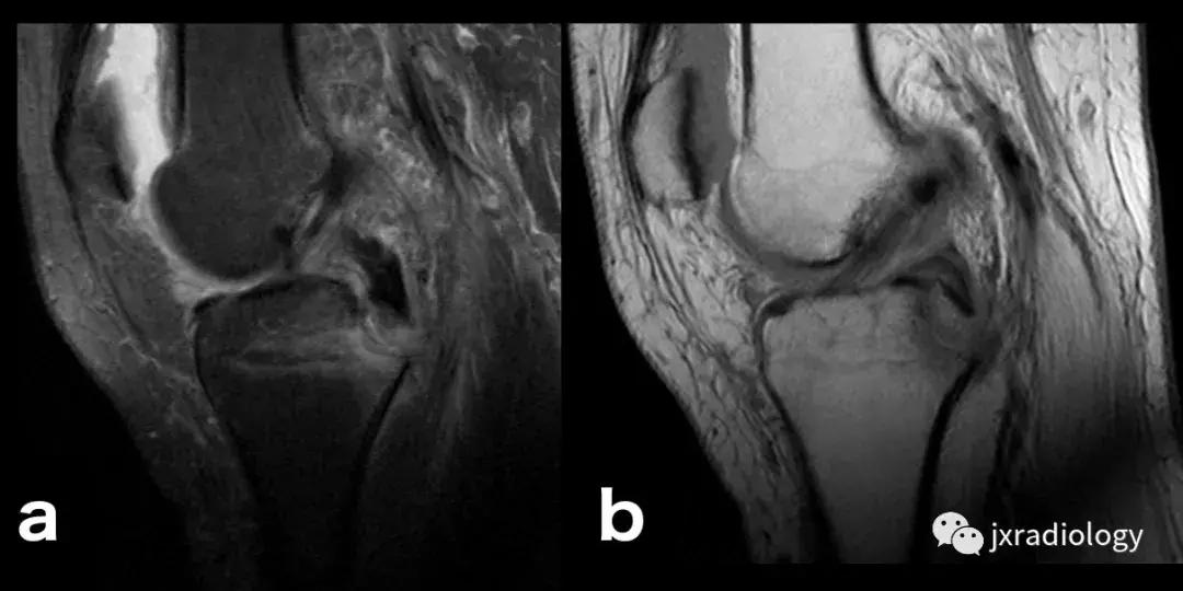 磁共振天天诊断骨髓水肿，但您知道原因吗？