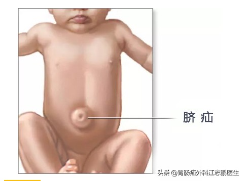 脐疝是什么意思呀,科普脐疝