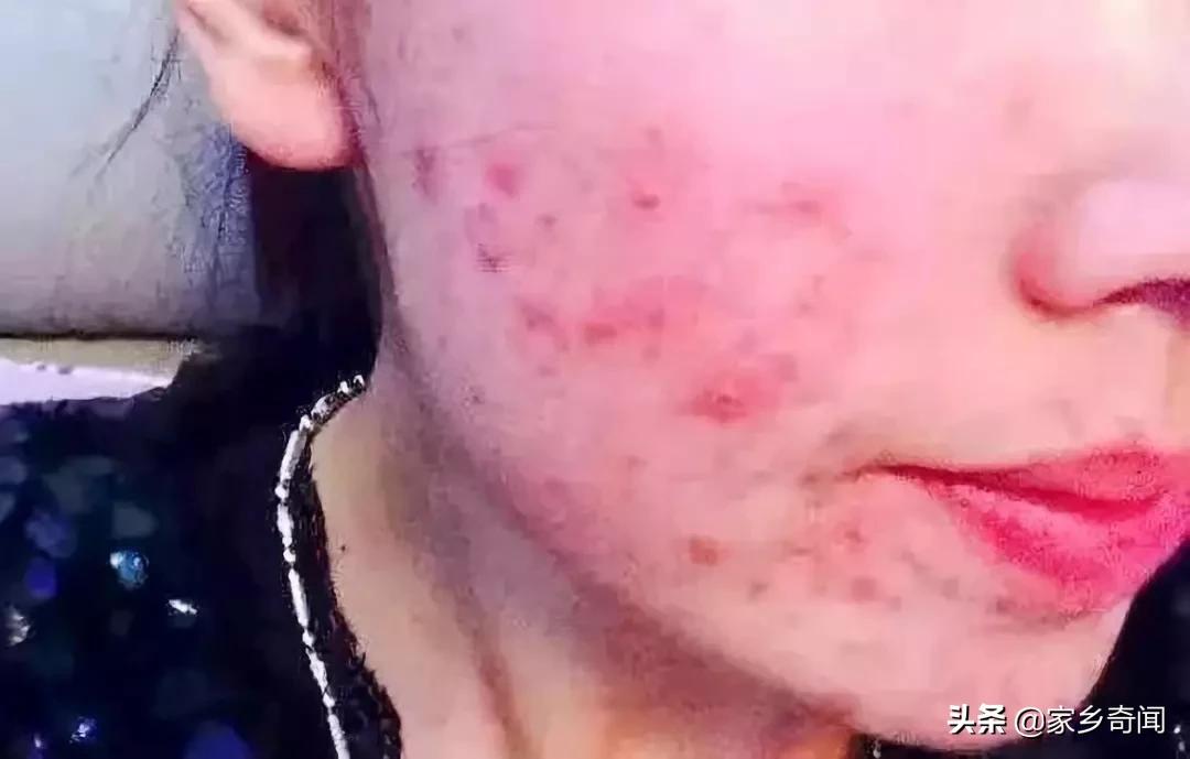 网红面膜去黑头粉刺,网红面膜可以天天用吗