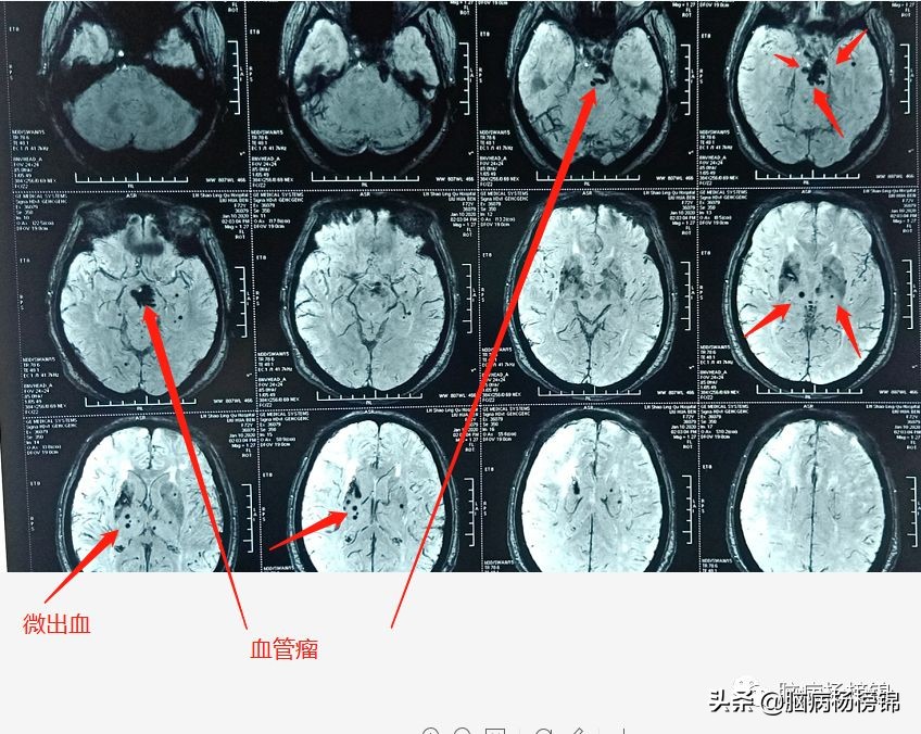 脑出血和脑梗塞同时出现已经昏迷,急性脑梗塞和急性脑出血同时出现