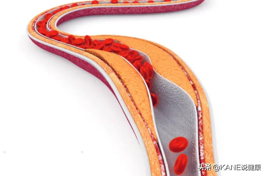 血液净化能控制血栓吗,血液净化真的能排油吗