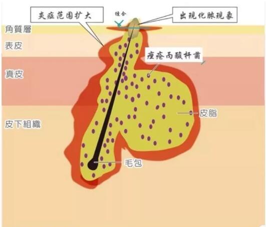 男士如何缩小脸部毛孔,脸部去黑头螨虫缩小毛孔