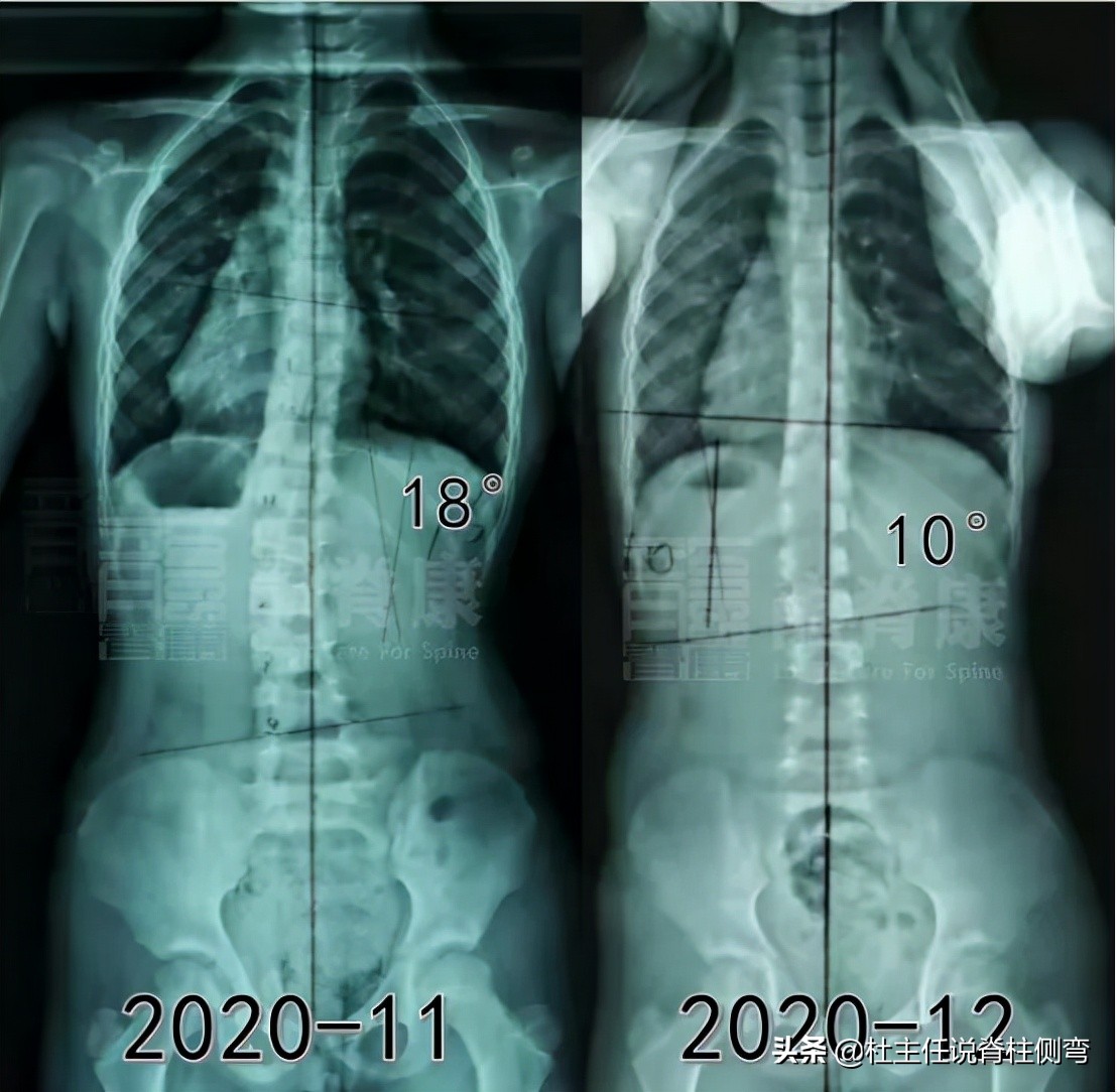 长短腿造成脊柱侧弯怎么治疗,脊柱侧弯长短腿怎么锻炼矫正视频
