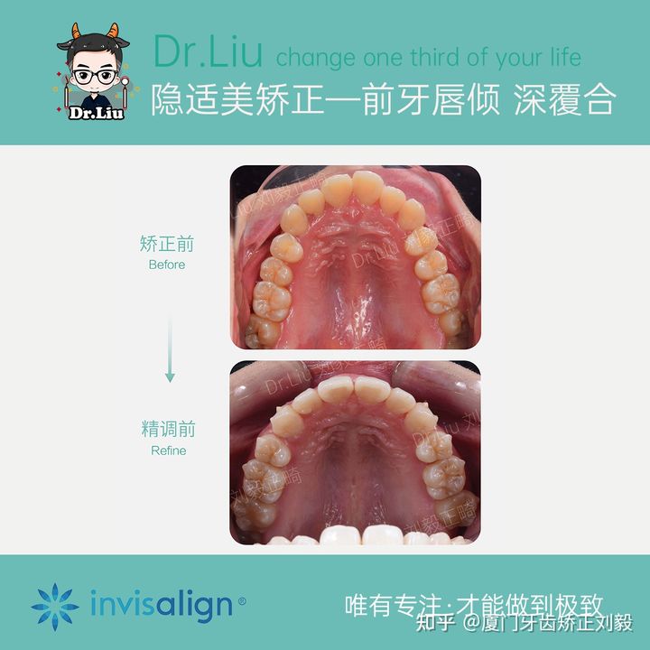厦门透明牙齿矫正器矫正时间,厦门成人隐形牙齿矫正价格