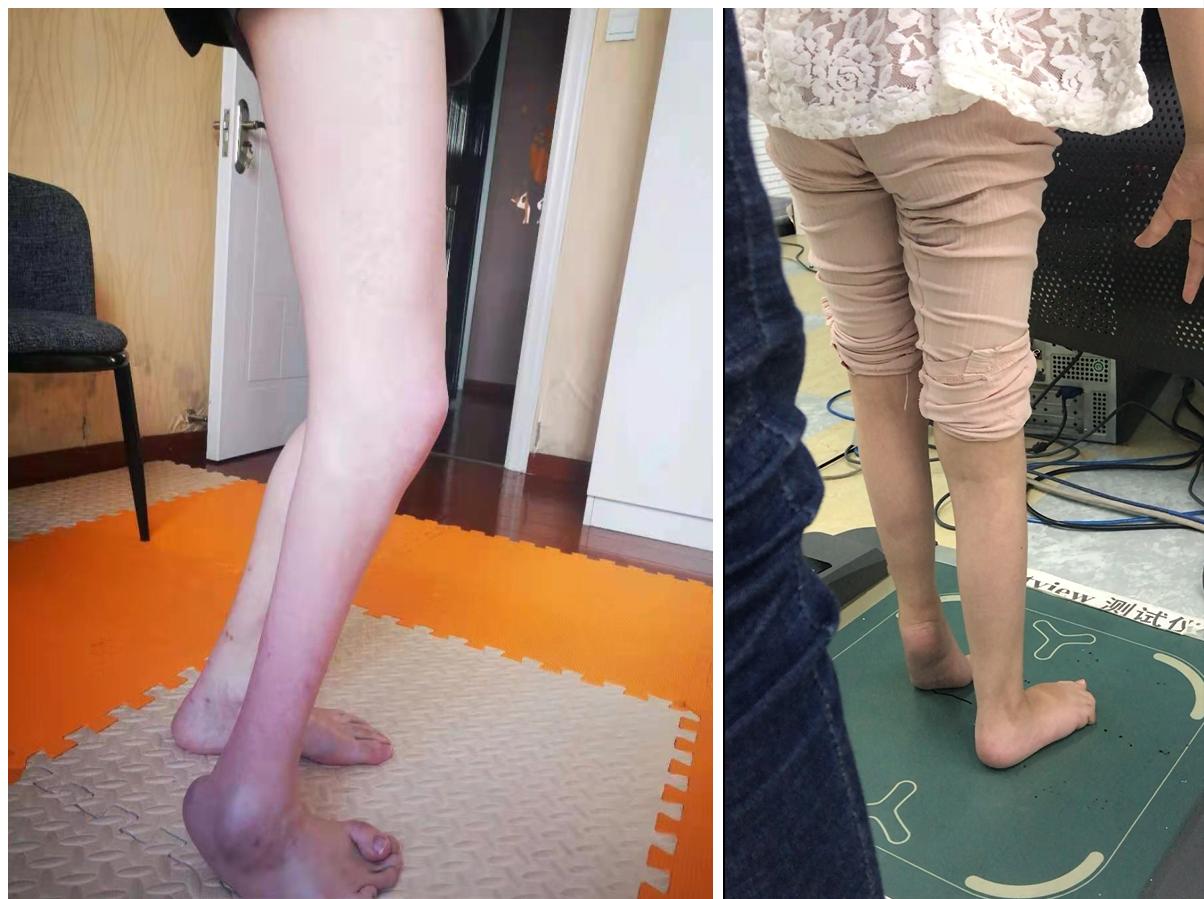 孩子足外翻买什么鞋矫正,儿童足外翻矫正鞋去哪里做