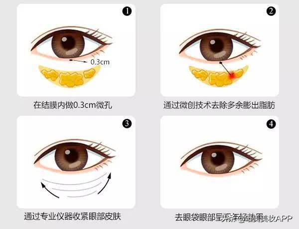 眼袋是不是只有手术才能去除,手术去除眼袋与激光去眼袋哪个好