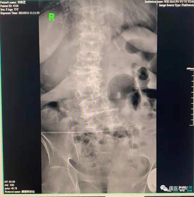 腰弯成s型怎么办,腰弯了会怎么样