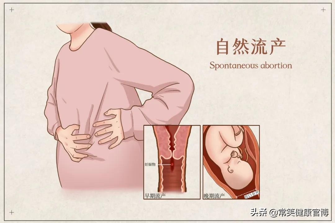 肚子里好好的孩子，怎么会不明原因流产？