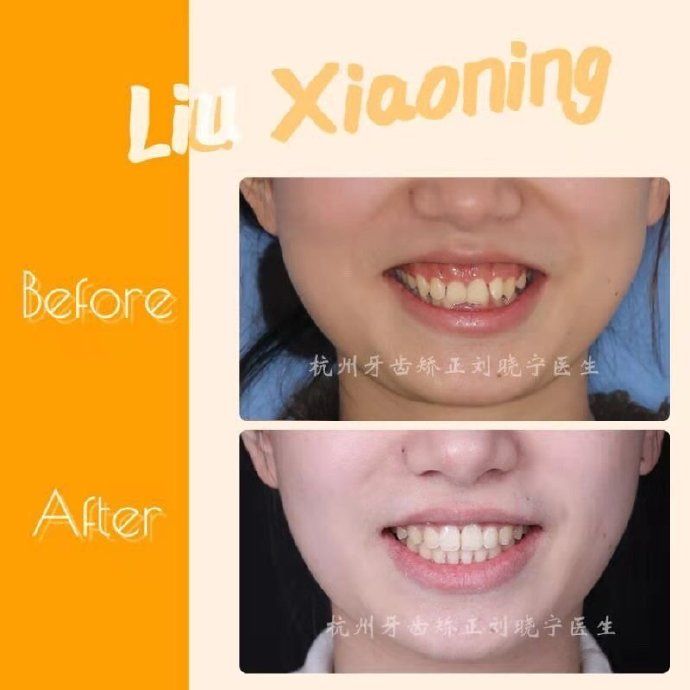 杭州牙齿矫正丨露龈笑怎么办?全面告别露龈笑的4大方法