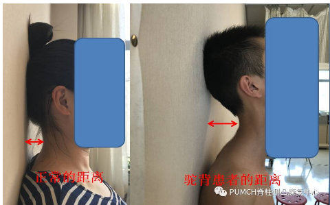 教你一招轻松搞定驼背,一秒纠正驼背超有效