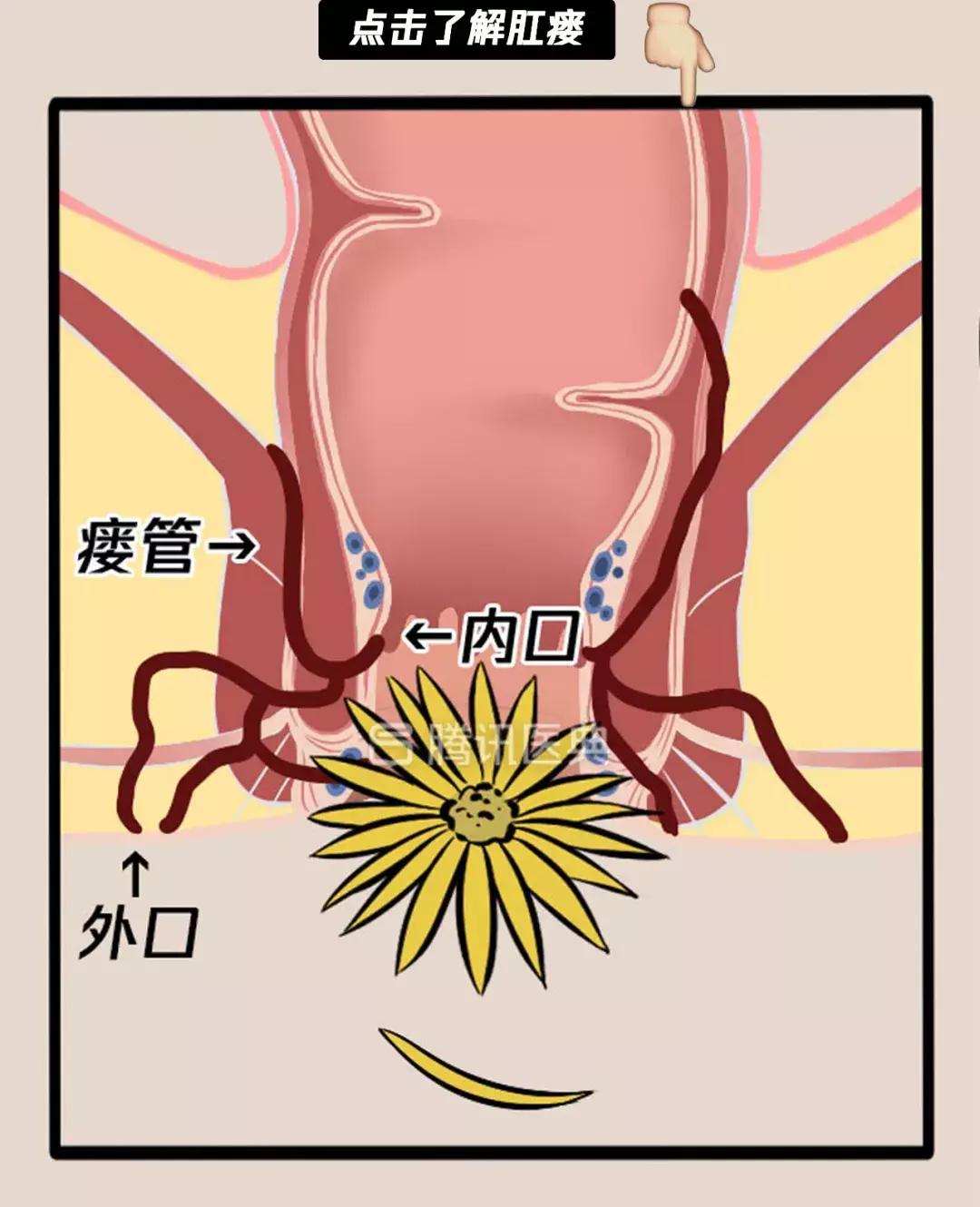 “*菊爆**后”痛到喊妈！真实看病经历泣血奉上，必须保护好菊花