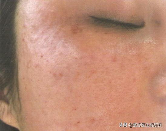 做完线雕半个月脸还是肿痛，是正常现象吗?知道的谈一谈