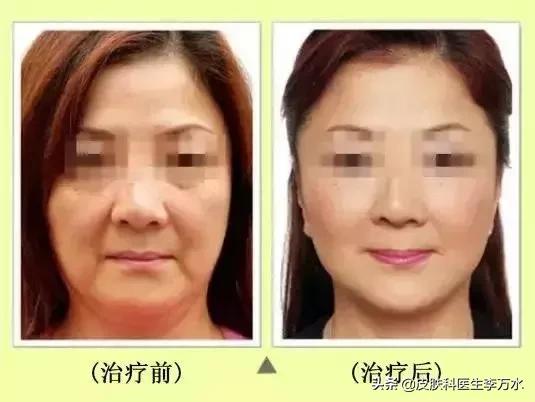 张雨绮说超声刀就像在烤肉？！线雕和超声刀，究竟哪个更靠谱？