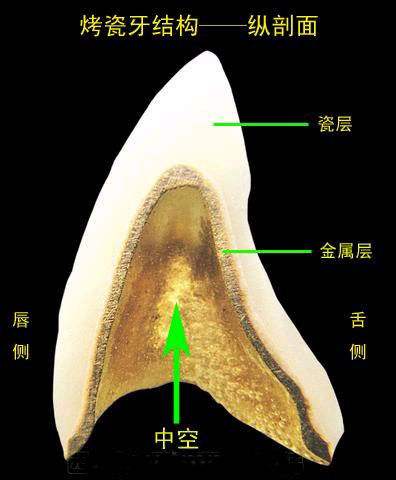 烤瓷牙崩了一块修复方法,烤瓷牙崩瓷了怎么修复