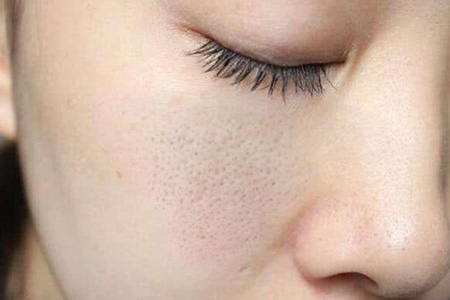 毛孔粗大的原因和护理方法,是什么原因导致毛孔粗大如何改善