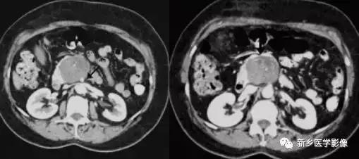 18种胰腺肿瘤，为什么我就知道两种