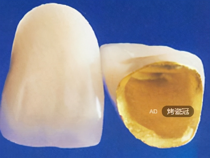 牙科医生讲义第十四讲：什么是 全 瓷 冠