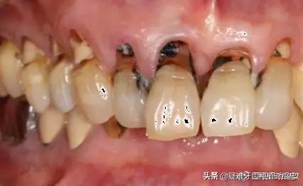 牙为啥会从里面开始烂,牙齿从牙根开始坏怎么回事
