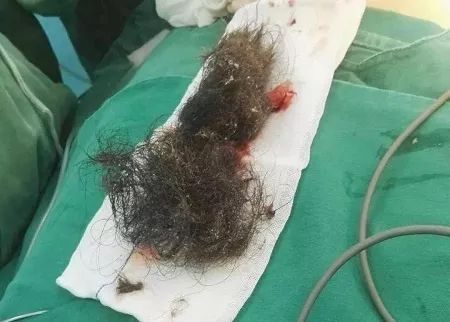 畸胎瘤为什么有毛骨头,51岁女子肚子里有畸胎瘤吗