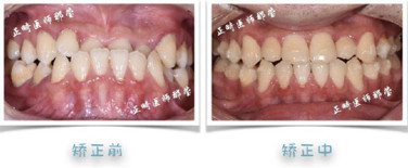 牙齿矫正10000元能搞定吗,牙齿矫正花费报销
