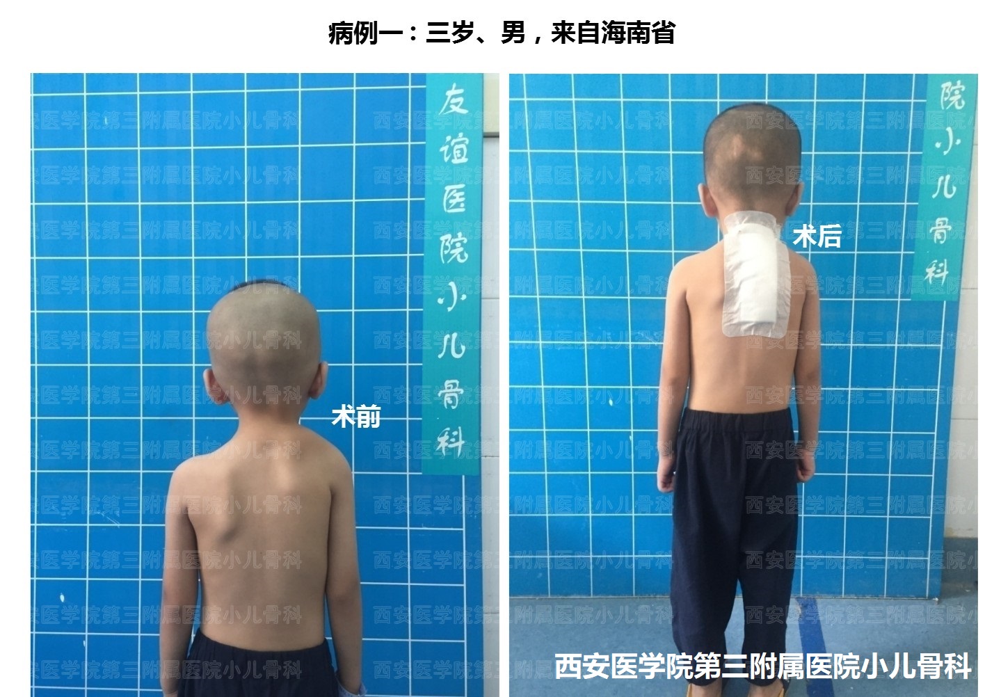 先天性高肩胛手术,先天性肩胛症通过手术需要多少钱