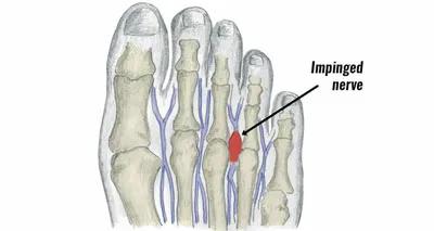 前脚掌疼痛,前足疼