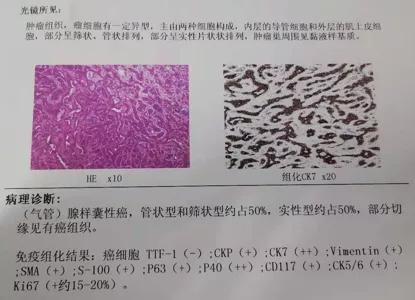 儿童90%为良性，成人却不到10%？患者气短3年，胸部CT提示的气管肿物意味着什么？气管镜有何发现？