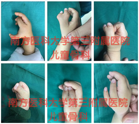 六指神童现在状况,新手六指怎么炼成大神六指