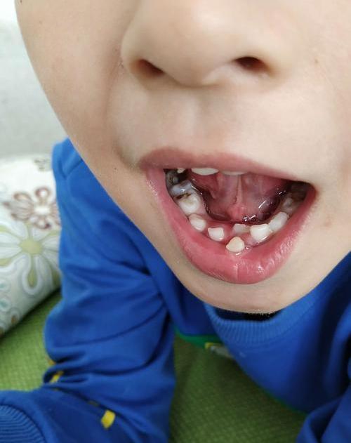 牙齿突然脱落是怎么回事,牙齿松动脱落是什么原因