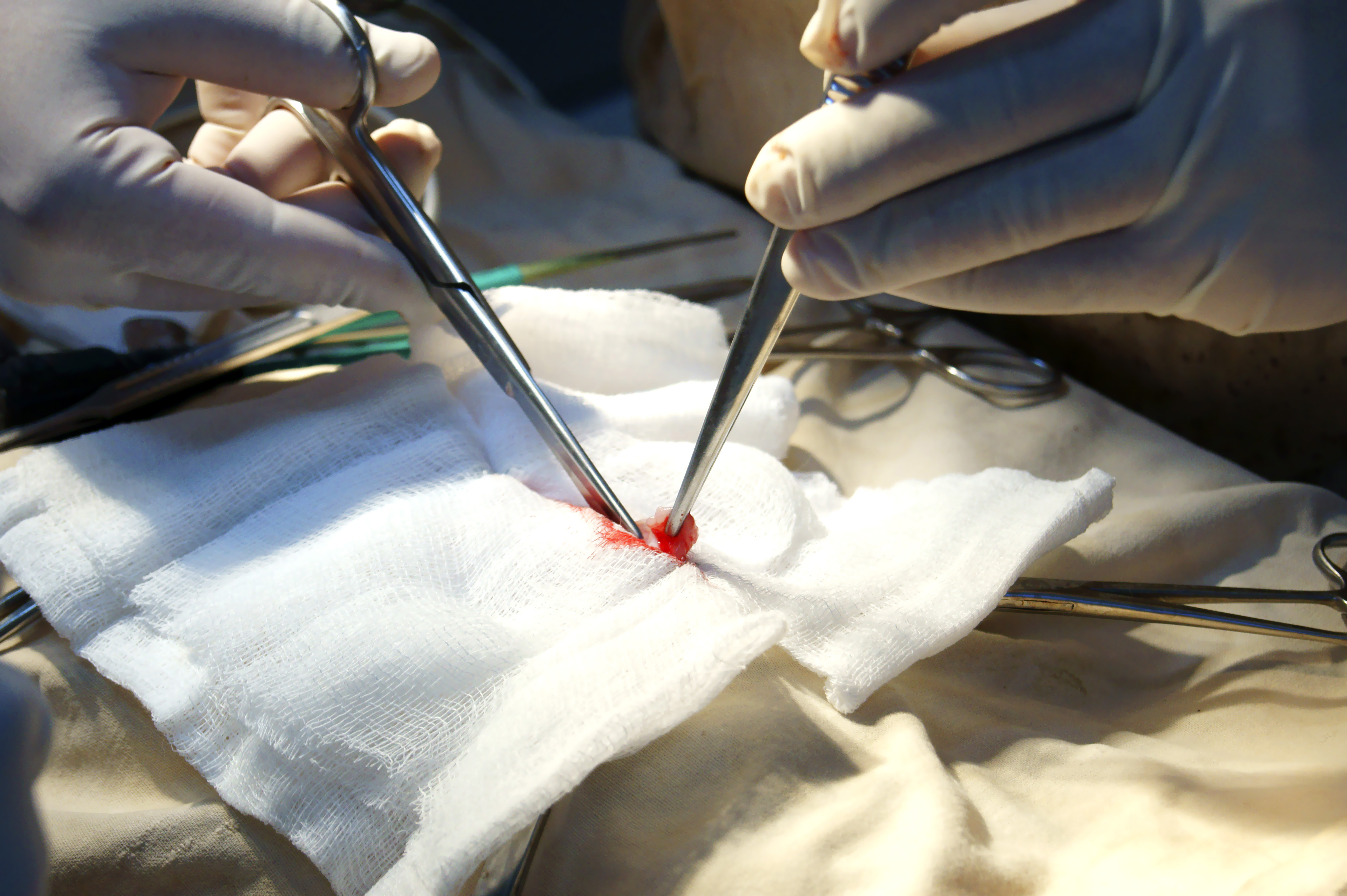 胃癌常用的食疗方法有哪些,胃癌内镜下切除的优缺点