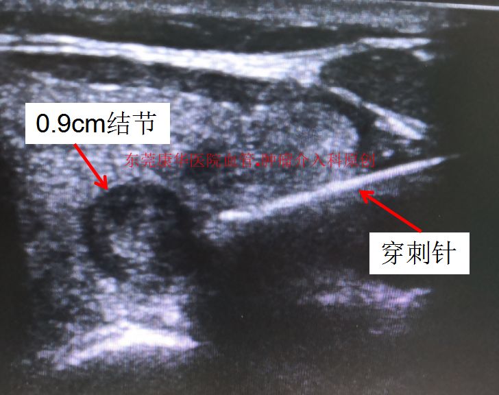 甲状腺结节微创消融手术,甲状腺结节微创消融医保