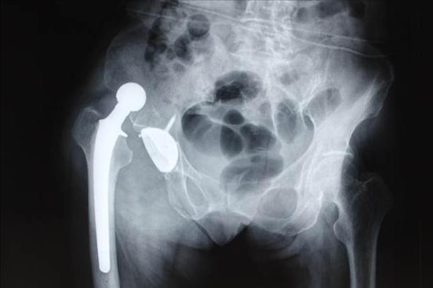 老年人关节病想置换人工关节，又担心副作用，该怎么办？